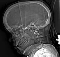 X-ray of a hydrocephalus