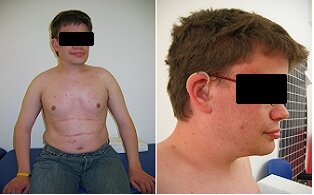 Young patient suffering from alpha-Mannosidosis